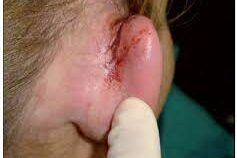 herida oreja